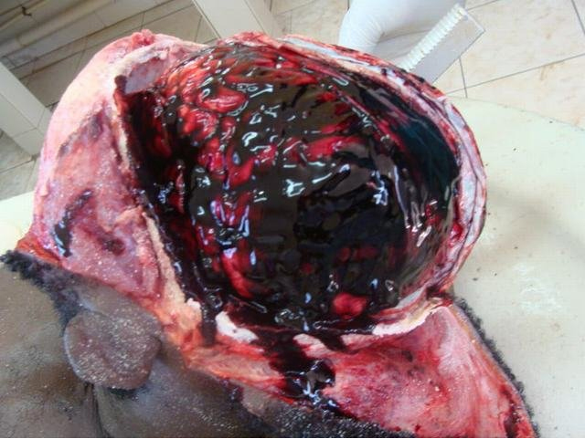 extradural hemorrhage